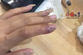 江苏南京一女子拔手指倒刺后发炎致骨髓炎住院：目前需要进行刮骨手术图片