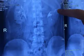 真实故事:贵州31岁男子力大如牛,轻松提300斤重物,4个肾吓坏医生图片