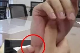 手腕三角纤维软骨复合体损伤是怎么回事？损伤后如何治疗？图片