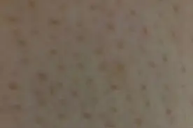 毛孔粗大，真的无法逆袭吗？图片