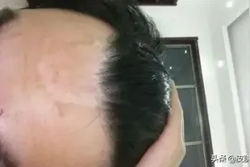 白癜风的病因有哪些？图片