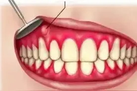 牙龈处反复长脓包是怎么回事？图片