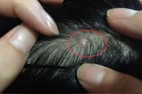 头皮里老是长疙瘩和脓包，是怎么回事？提醒：或是4种疾病的预警图片