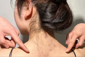 满背痤疮痘痘和闭口！过来人总结三步祛痘法！居家洗洗痘痘就掉！图片