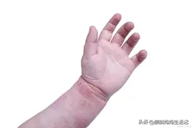 夏季孩子皮肤痒，不止“湿疹”和“痱子”，还有这种被忽略的原因图片