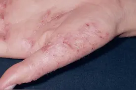 万能皮肤“神药”炉甘石洗剂的7种联合用药方案图片