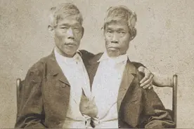 连体人会同时死亡吗？连体兄弟死后，健康的一方也在2小时后死亡图片