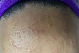 小孩脸上黑头粉刺反反复复，咋去除图片