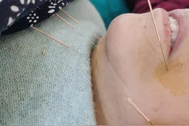 老娘得了脑梗，第一次近距离接触针灸，看看这针扎的，震撼！图片