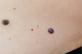 身体反复出现“红点”？注意！这些病可能和你有关图片