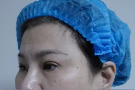 一时冲动，52岁这一年做了大拉皮，刚做完，想说几句心里话图片