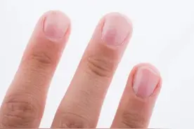 指甲盖上有竖纹，这是咋回事？真是老人说得“肝脏不好”？图片