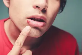 科普 | 嘴巴周围时不时出现“几个水泡”？提醒：这不是“上火”，会传染！图片