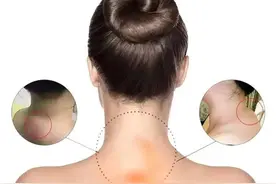 “富贵包”等于夺命包？竟是气血淤堵的警告，中医3个妙招帮你缓解图片