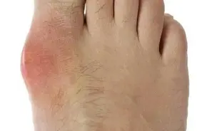 痛风不能吃鱼？医生辟谣：这些鱼能吃，另外八种尽量避免图片