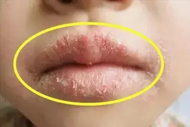 孩子感冒发烧咳嗽丨煮一碗甜水，让“烧”走的津液自己补回去！图片