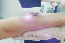 激光脱毛对1种“毛”效果最好！医生将13个问题一次性说明白图片