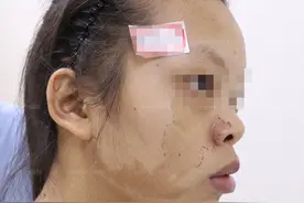 郑州市第二中医院：咖啡斑有什么危害？图片