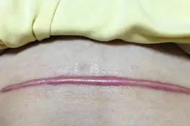 剖宫产疤痕痒吗？中招的看过来图片