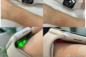 苹果手表致使多名用户手腕红肿，甚至曾发热爆炸，涉及多个型号图片
