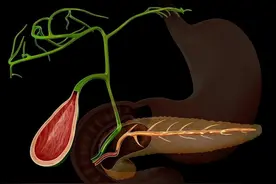 胆囊切除后，有哪些后遗症？医生：或有5种结局，建议早了解图片