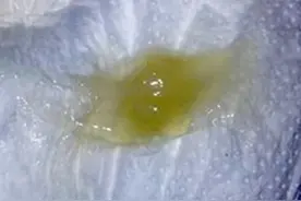 “阳康”后咳黄痰不意味着细菌感染？痰液到底为什么会变黄？图片