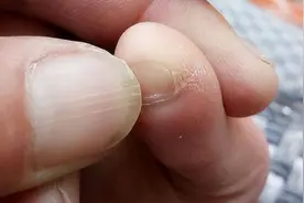 小脚趾指甲分成两瓣的人，到底是什么来历？你的指甲也这样吗？图片