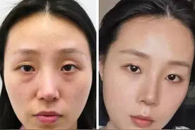 如何判定自己是不是鼻基底凹陷？快看看这5大症状，你中了几个？图片