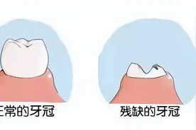 “烂牙根”不拔的3大后果，一不小心就会引起各种口腔问题图片