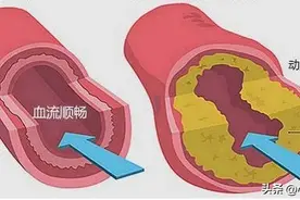 血脂正常了，可以停药吗？图片