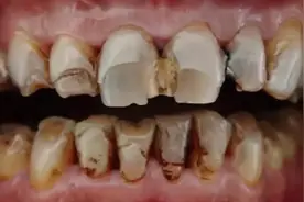 吸烟过多牙齿发黄发黑怎么办？只需三招，在家就能快速去烟渍！图片