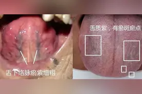 舌下青筋又粗又黑？中医：血瘀严重！4种舌象，教你正确化瘀血图片