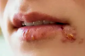 嘴上长水泡瘙痒、刺痛？别以为只是上火而已，4个情况要留意图片