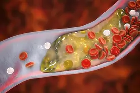 身体哪些表现，怀疑血脂高！3个办法判断，第3个最准确图片