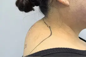 富贵包越治越大，56岁胆小害怕手术，微创一个小口解决问题图片