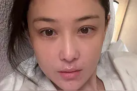 “军嫂”张馨予晒纯素颜照自曝患皮炎，患处布满红色疙瘩：爆发期真的很吓人，我都不好意思给大家看图片