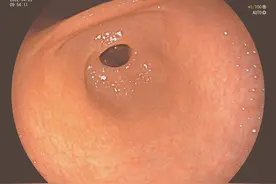 幽门螺杆菌感染可导致胃黏膜呈鸡皮样改变图片