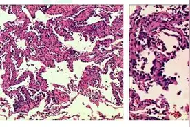 老骥伏枥，76岁上“战场”抗击肺癌，单孔胸腔镜歼灭原位癌图片