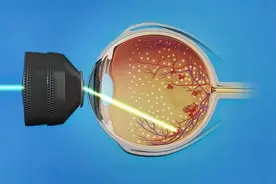 第一批用激光手术治近视的人，现在眼睛怎么样了？有后遗症吗？图片