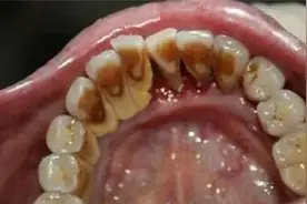 黑黝黝牙渍去不掉？掌握这几招，牙齿立刻变得洁白如新！图片