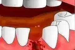 拔牙后不能吐口水？避免出现干槽症，这些拔牙术后事项要牢记！图片