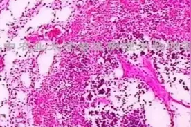 反复高热不退，抗生素无效，淋巴结肿大，原因？怎么应对呢？图片