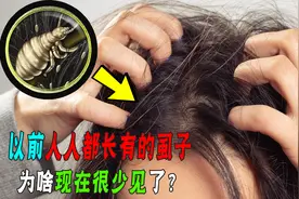 几十年前人人都长有的虱子，为啥现在不见了？真消失了吗？图片