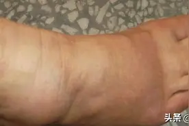 脚肿的“根源”找到了！最怕的是这3种，尤其第一个！图片