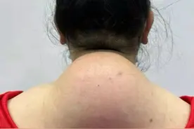 富贵包10多年了，从南京到上海做了微创手术图片