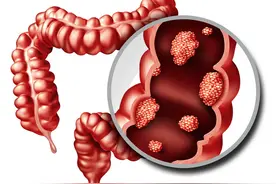 肠癌多是“拖”出来的，出现这5种迹象，肠道或已“病”得不轻图片