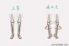 拯救扁平足，从换一双鞋子开始图片