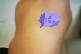 手腕突然长个包，压着有点疼，咋回事？图片