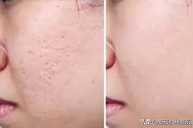 凹陷疤痕预防、用药、治疗、费用，看这一篇就够了！图片
