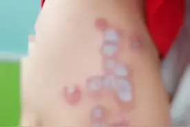 3岁孩子皮肤溃烂！医生：经接触传染！夏季去这种地方要注意图片